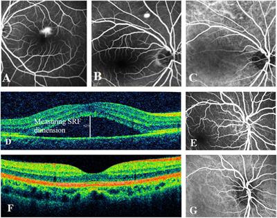 Discovery of Novel Genetic Risk Loci for Acute Central Serous Chorioretinopathy and Genetic Pleiotropic Effect With Age-Related Macular Degeneration